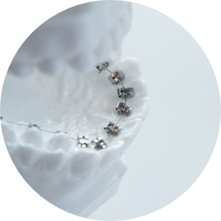 裏側矯正（リンガル矯正）