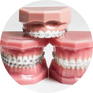 表側矯正（ラビアル矯正）