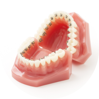 裏側矯正（リンガル矯正）